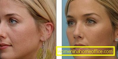Botox före och efter: foto